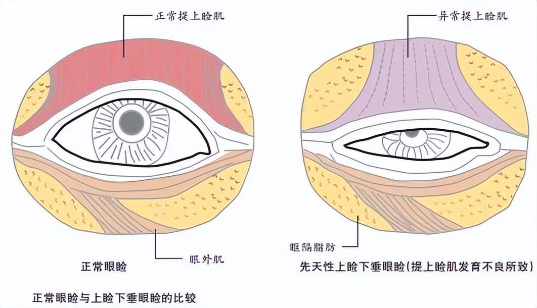 这类眼睛不做提肌，双眼皮也等于白做！