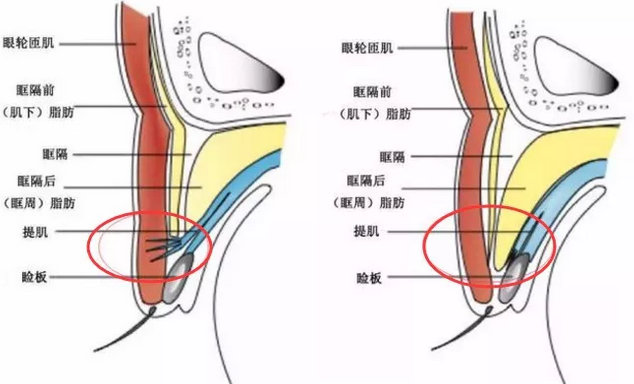 单眼皮是怎么变成双眼皮的？