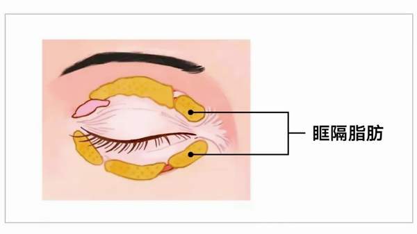 眼袋祛除眶膈脂肪多少合适？