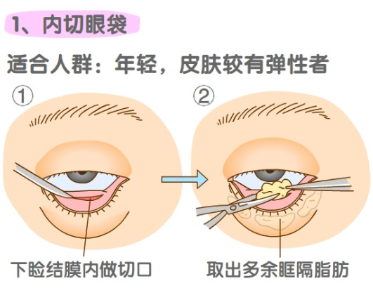 内切祛眼袋比外切祛眼袋好吗？