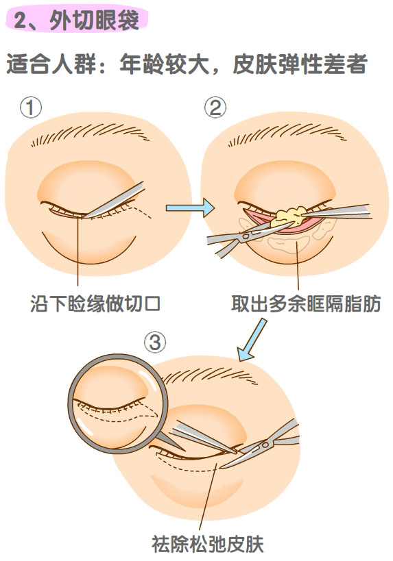 内切祛眼袋比外切祛眼袋好吗？